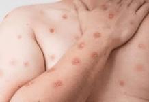 Alerta máximo: Goiânia, Anápolis e mais cinco municípios confirmam casos suspeitos do vírus Mpox